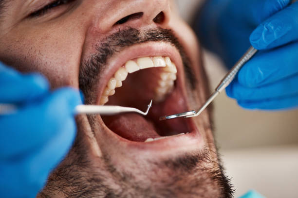 Best Emergency Dental Extractions in Cookeville, TN
